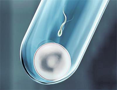 体外受精 IVF-ET